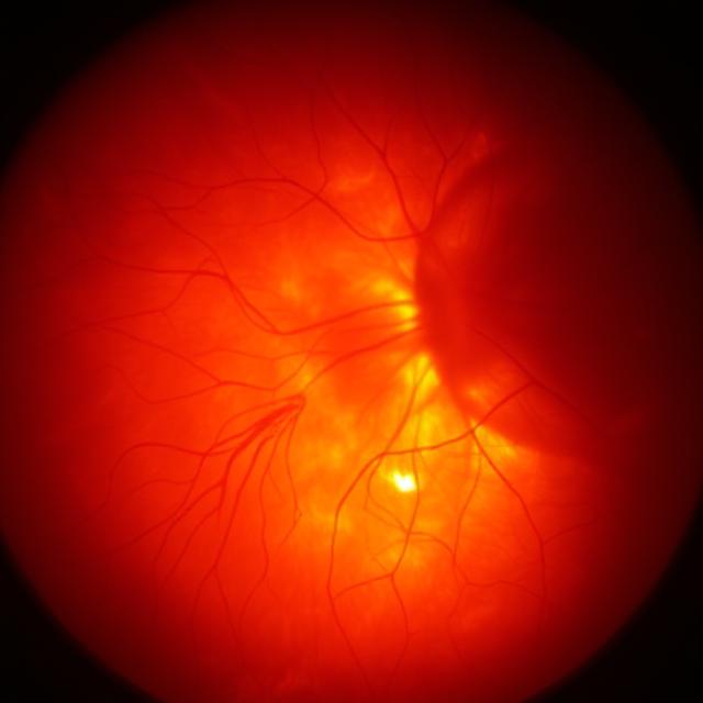 Effect of Photobiomodulation in Suppression of Oxidative Stress on Retinal Pigment Epithelium